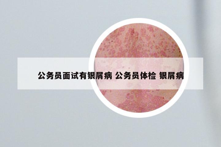 公务员面试有银屑病 公务员体检 银屑病