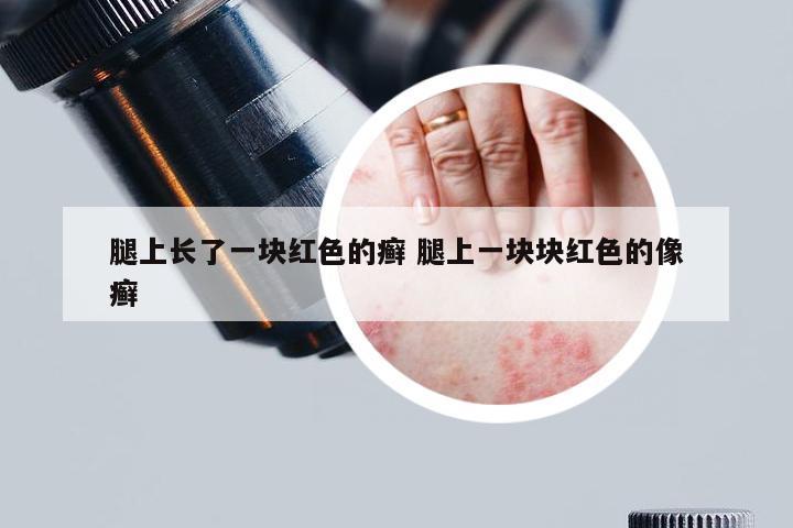 腿上长了一块红色的癣 腿上一块块红色的像癣
