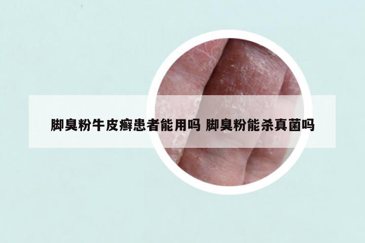 脚臭粉牛皮癣患者能用吗 脚臭粉能杀真菌吗