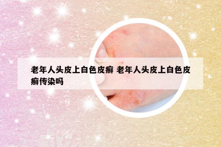 老年人头皮上白色皮癣 老年人头皮上白色皮癣传染吗