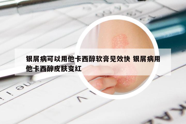 银屑病可以用他卡西醇软膏见效快 银屑病用他卡西醇皮肤变红