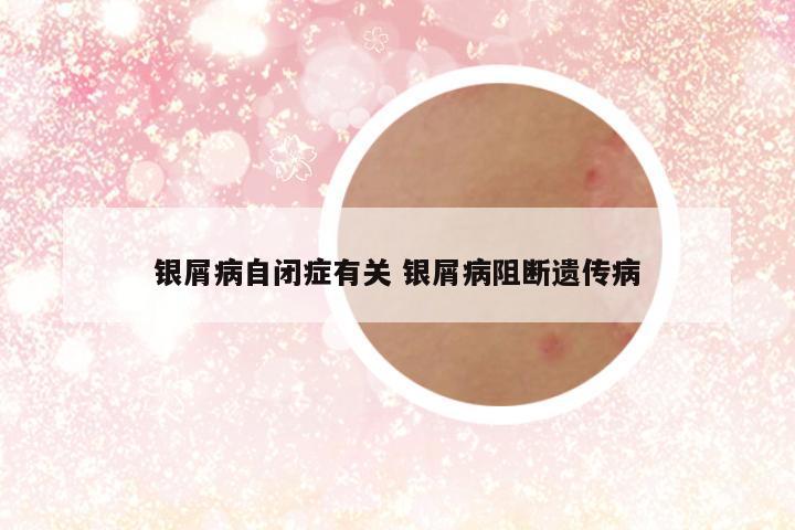 银屑病自闭症有关 银屑病阻断遗传病