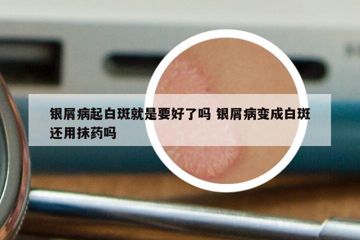 银屑病起白斑就是要好了吗 银屑病变成白斑还用抹药吗