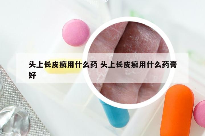 头上长皮癣用什么药 头上长皮癣用什么药膏好