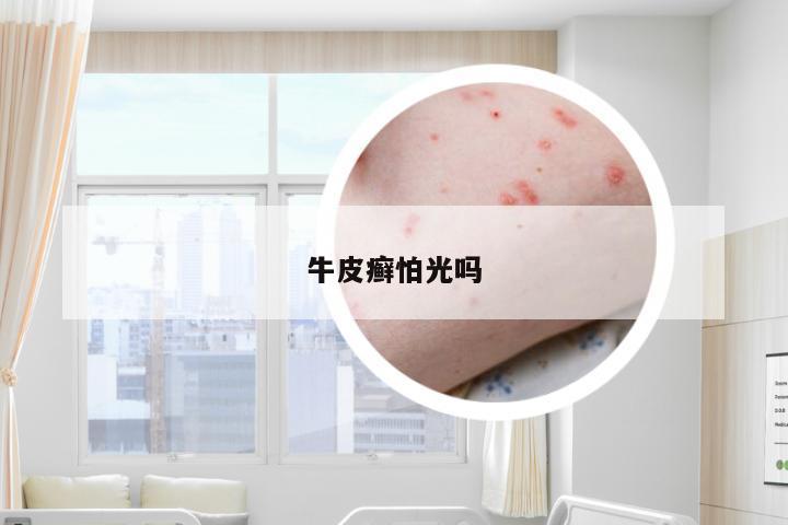 牛皮癣怕光吗