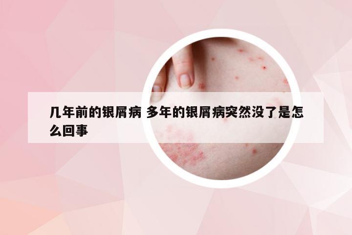几年前的银屑病 多年的银屑病突然没了是怎么回事