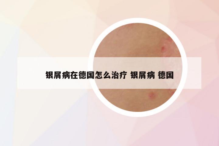 银屑病在德国怎么治疗 银屑病 德国
