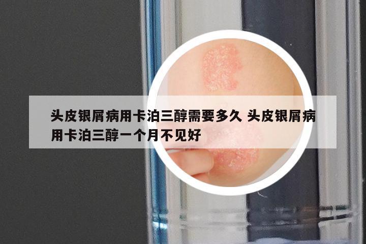 头皮银屑病用卡泊三醇需要多久 头皮银屑病用卡泊三醇一个月不见好
