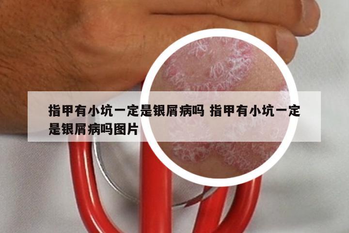 指甲有小坑一定是银屑病吗 指甲有小坑一定是银屑病吗图片
