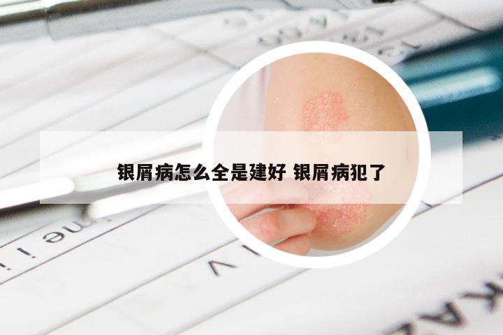 银屑病怎么全是建好 银屑病犯了