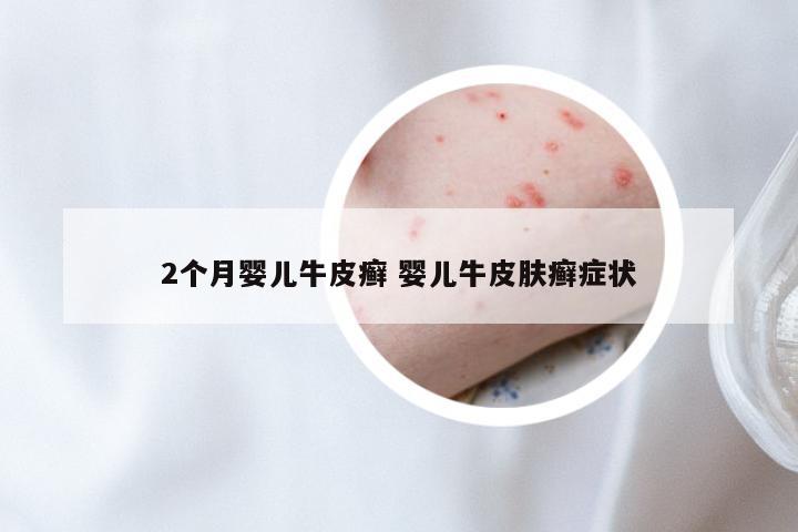 2个月婴儿牛皮癣 婴儿牛皮肤癣症状