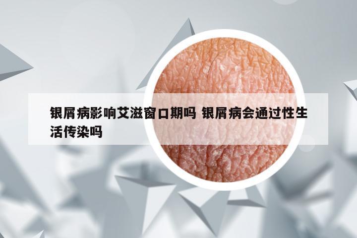 银屑病影响艾滋窗口期吗 银屑病会通过性生活传染吗