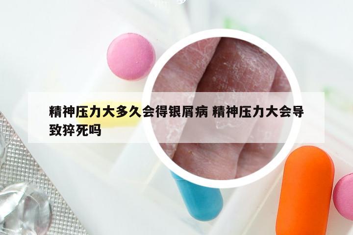 精神压力大多久会得银屑病 精神压力大会导致猝死吗