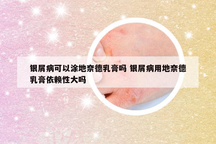 银屑病可以涂地奈德乳膏吗 银屑病用地奈德乳膏依赖性大吗