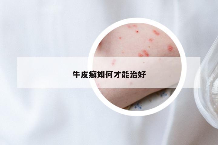 牛皮癣如何才能治好