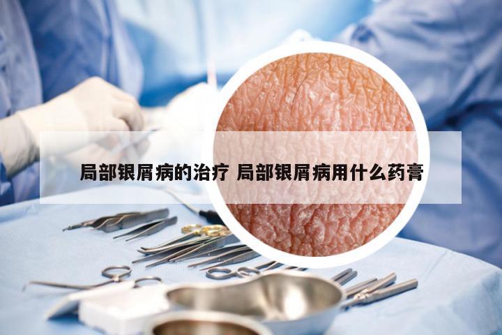 局部银屑病的治疗 局部银屑病用什么药膏
