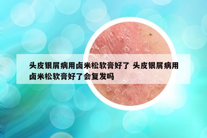 头皮银屑病用卤米松软膏好了 头皮银屑病用卤米松软膏好了会复发吗