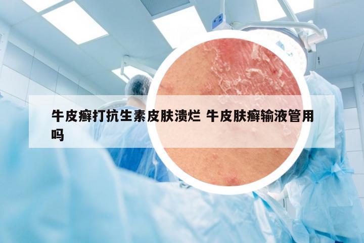 牛皮癣打抗生素皮肤溃烂 牛皮肤癣输液管用吗