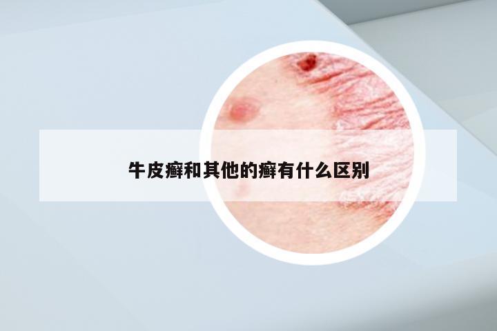 牛皮癣和其他的癣有什么区别