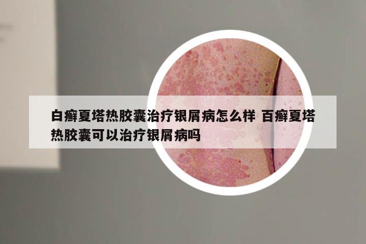 白癣夏塔热胶囊治疗银屑病怎么样 百癣夏塔热胶囊可以治疗银屑病吗