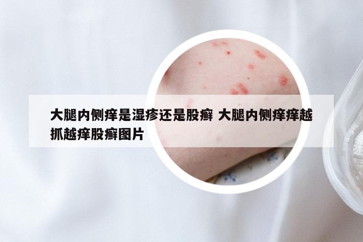 大腿内侧痒是湿疹还是股癣 大腿内侧痒痒越抓越痒股癣图片