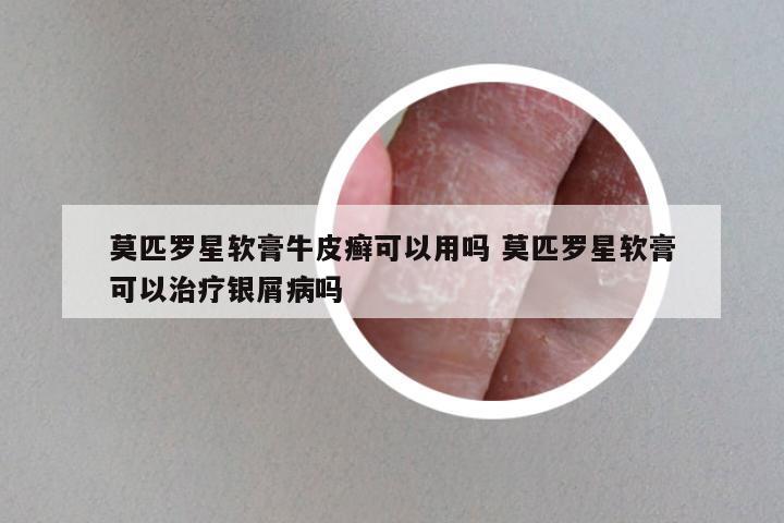 莫匹罗星软膏牛皮癣可以用吗 莫匹罗星软膏可以治疗银屑病吗