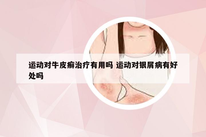 运动对牛皮癣治疗有用吗 运动对银屑病有好处吗