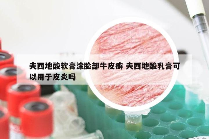 夫西地酸软膏涂脸部牛皮癣 夫西地酸乳膏可以用于皮炎吗
