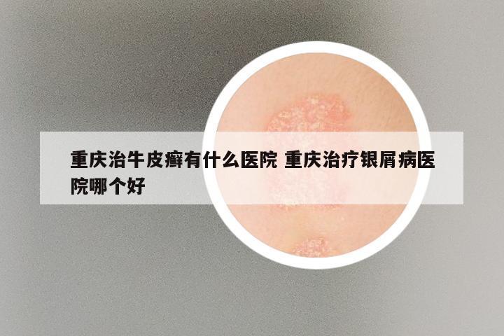 重庆治牛皮癣有什么医院 重庆治疗银屑病医院哪个好