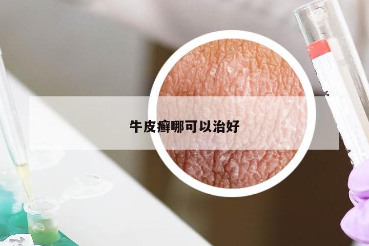 牛皮癣哪可以治好