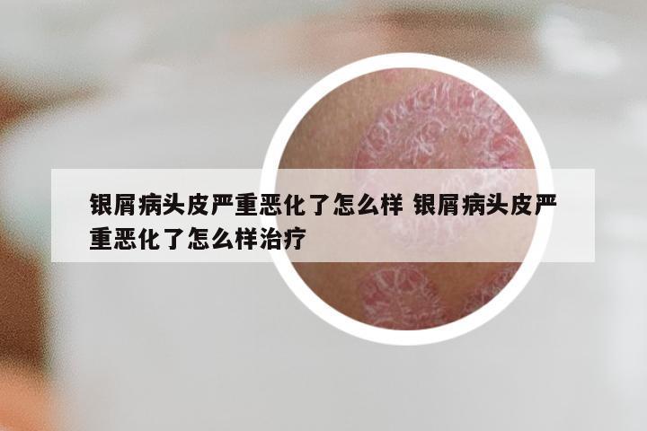银屑病头皮严重恶化了怎么样 银屑病头皮严重恶化了怎么样治疗