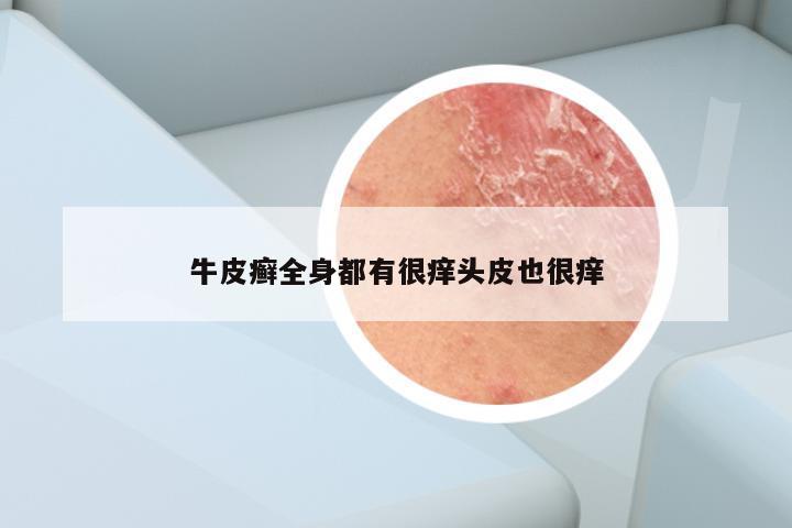 牛皮癣全身都有很痒头皮也很痒