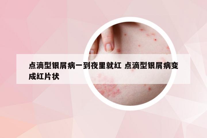 点滴型银屑病一到夜里就红 点滴型银屑病变成红片状