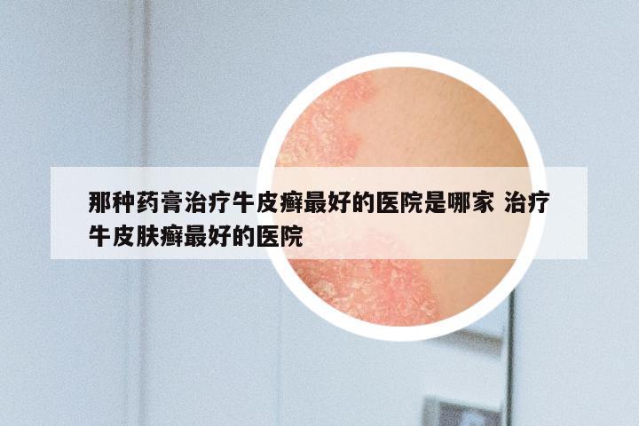 那种药膏治疗牛皮癣最好的医院是哪家 治疗牛皮肤癣最好的医院