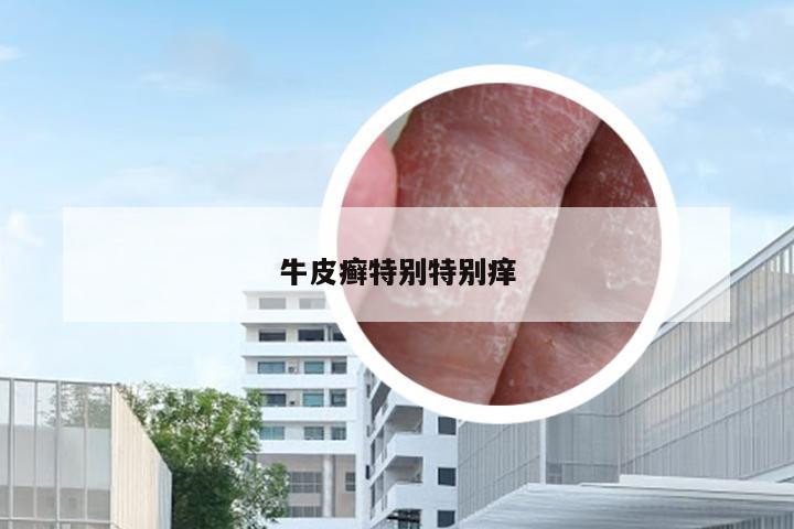 牛皮癣特别特别痒