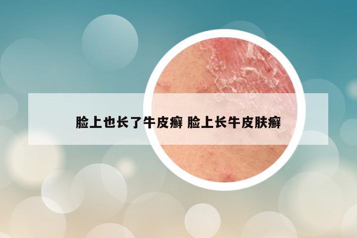 脸上也长了牛皮癣 脸上长牛皮肤癣