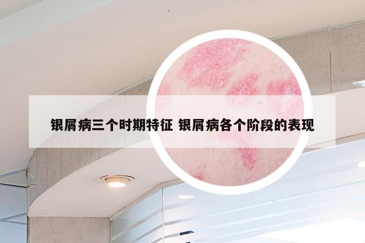 银屑病三个时期特征 银屑病各个阶段的表现