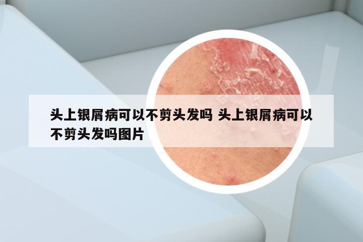 头上银屑病可以不剪头发吗 头上银屑病可以不剪头发吗图片