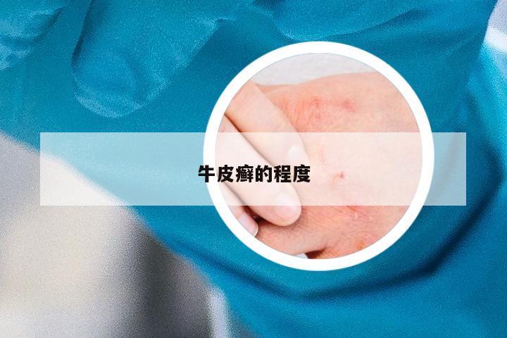 牛皮癣的程度