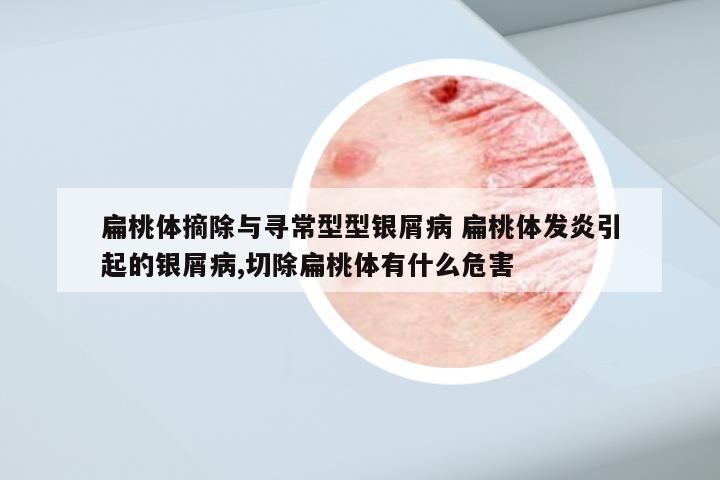 扁桃体摘除与寻常型型银屑病 扁桃体发炎引起的银屑病,切除扁桃体有什么危害