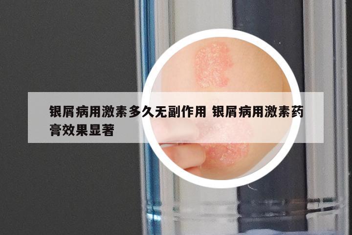 银屑病用激素多久无副作用 银屑病用激素药膏效果显著