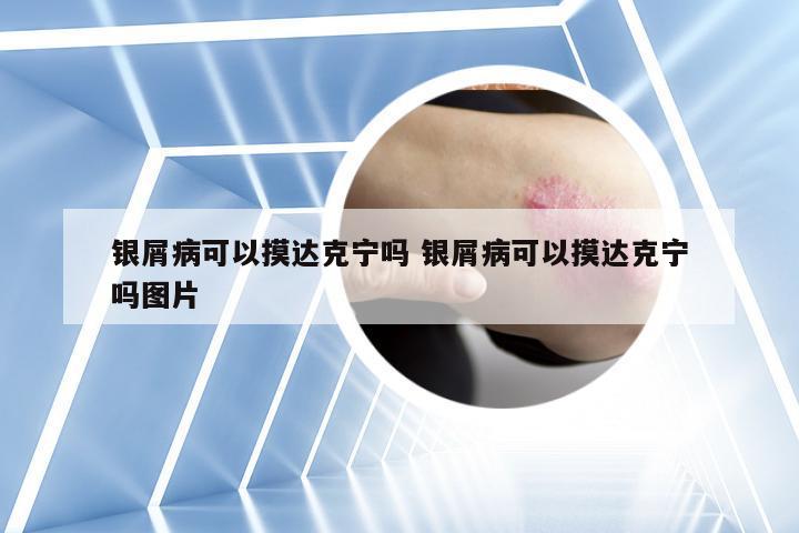 银屑病可以摸达克宁吗 银屑病可以摸达克宁吗图片