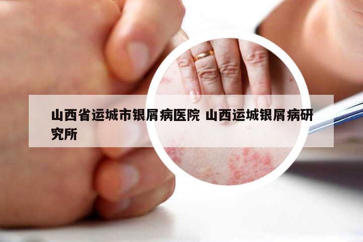 山西省运城市银屑病医院 山西运城银屑病研究所
