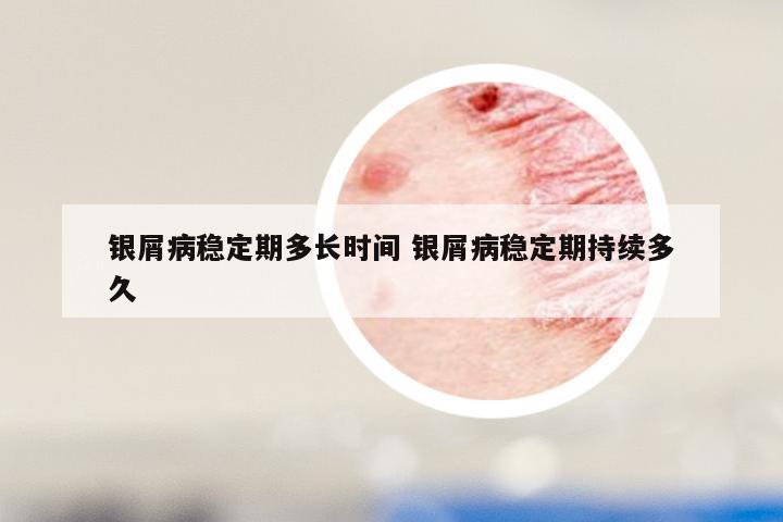 银屑病稳定期多长时间 银屑病稳定期持续多久