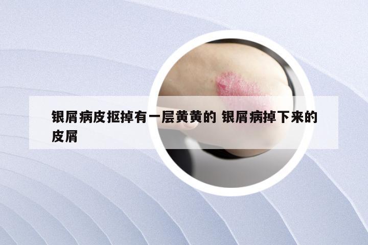 银屑病皮抠掉有一层黄黄的 银屑病掉下来的皮屑
