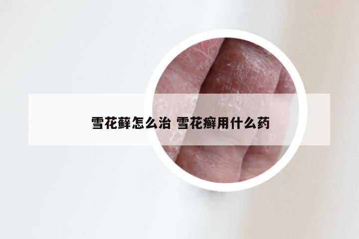 雪花藓怎么治 雪花癣用什么药