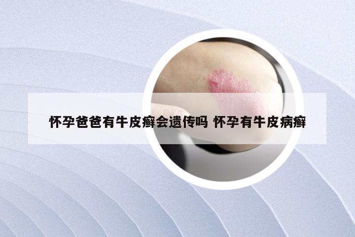 怀孕爸爸有牛皮癣会遗传吗 怀孕有牛皮病癣