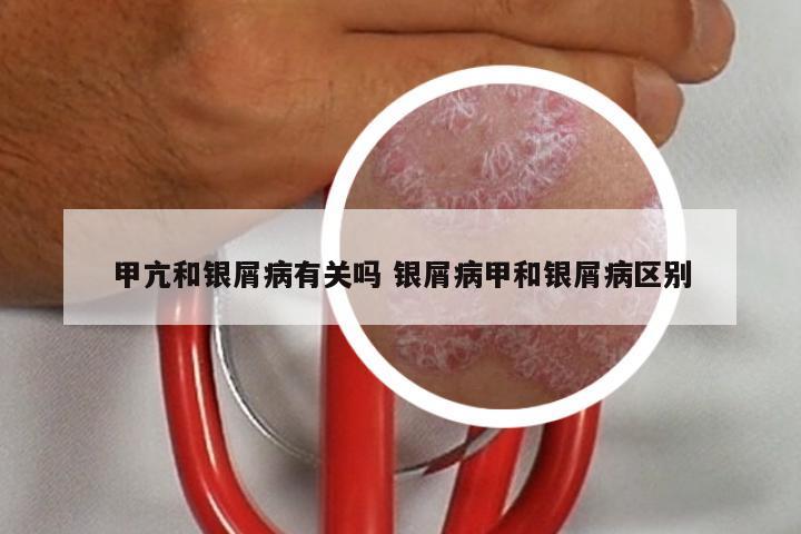 甲亢和银屑病有关吗 银屑病甲和银屑病区别
