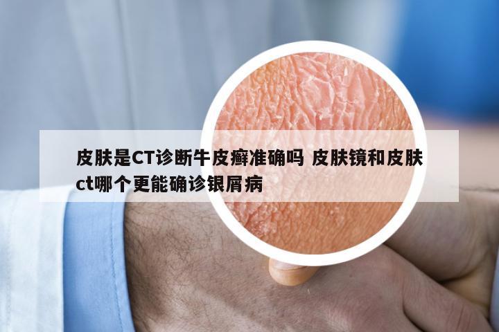 皮肤是CT诊断牛皮癣准确吗 皮肤镜和皮肤ct哪个更能确诊银屑病