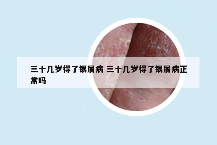 三十几岁得了银屑病 三十几岁得了银屑病正常吗